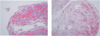 Histopathology of Psoriatic Arthritis Synovium—A Narrative Review